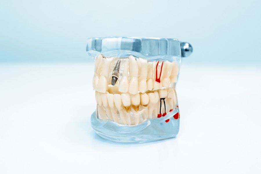 Multiple Dental Implants Multiple Dental Implants